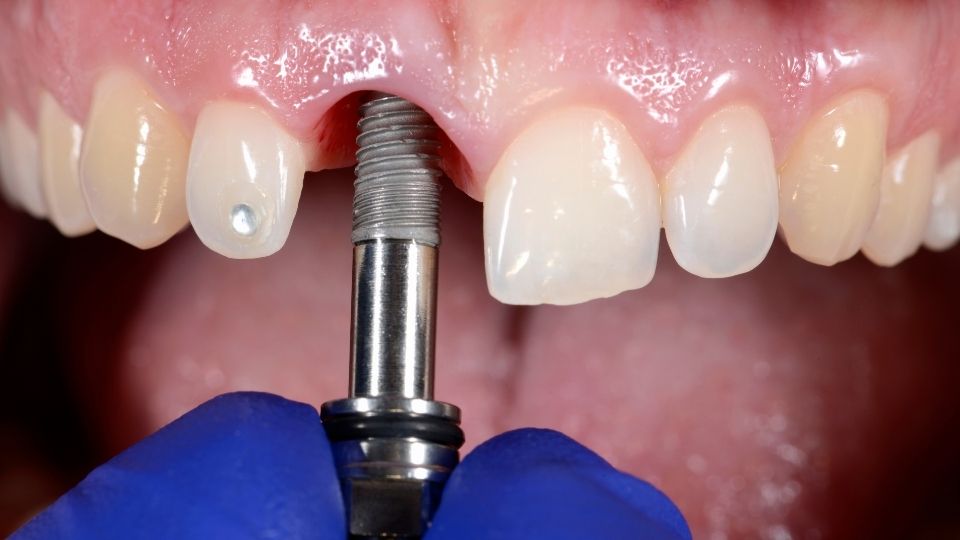A Person Getting Dental Implant