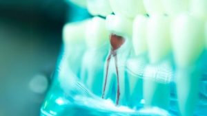 Root Canal Procedure: How Long Does it Take?